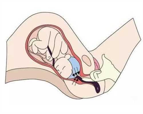 不能受孕可以代孕吗·双侧卵巢多囊样改变是什么
